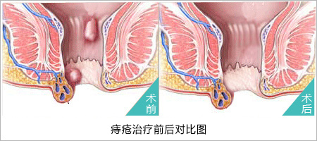 想知道痔疮的怎么治疗较好吗?